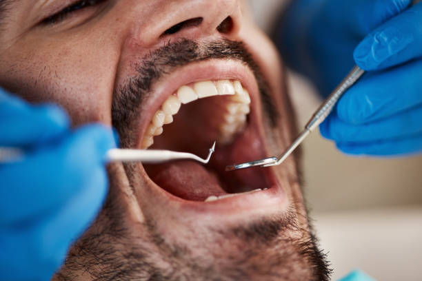 Best Emergency Dentist for Knocked-Out Tooth in North Fort Myers, FL