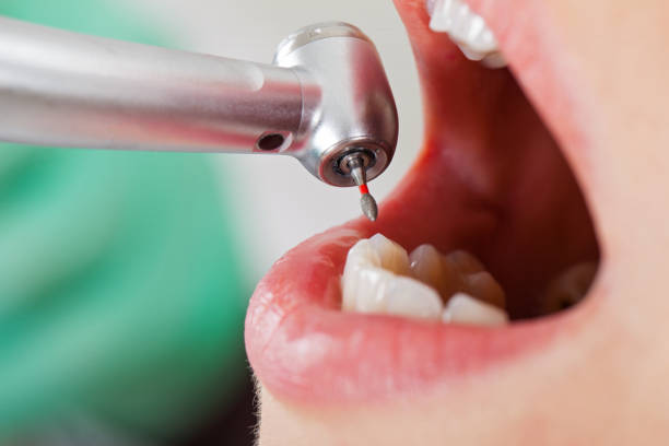 Best Emergency Dentist for Lost Fillings or Crowns in North Fort Myers, FL